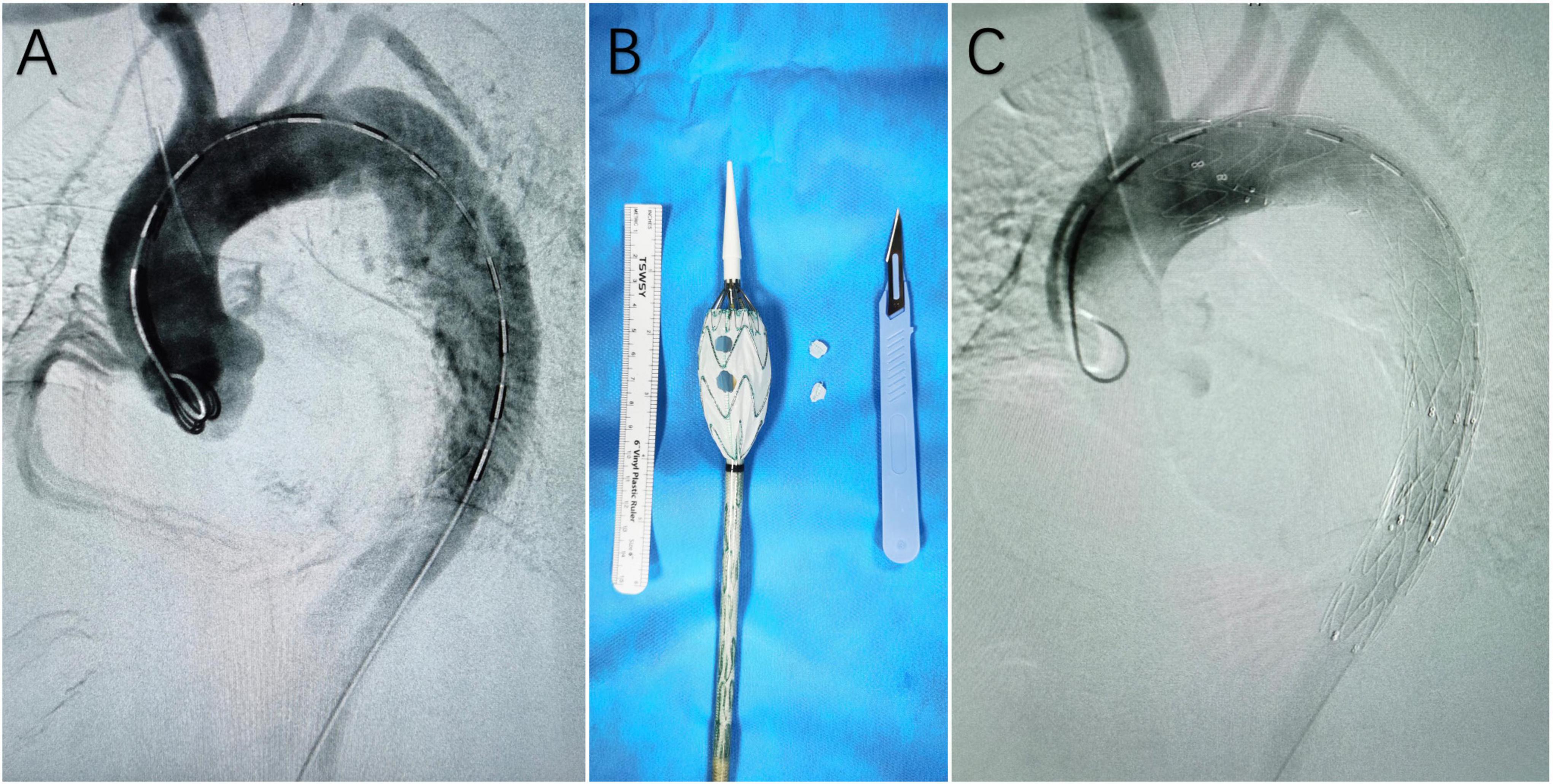 Outcomes of thoracic endovascular aortic repair with fenestrated surgeon-modified stent-graft for type B aortic dissections involving the aortic arch